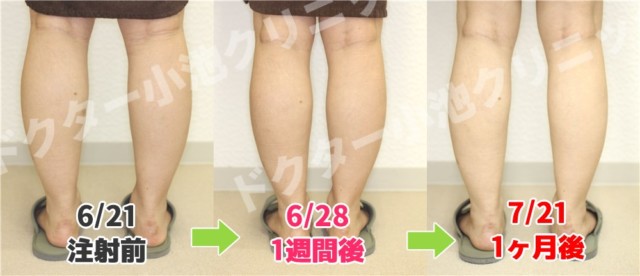 ドクター小池クリニックのボトックス注射でのビフォーアフター